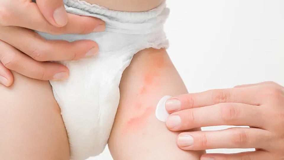 Treating Diaper Rash with the Right Baby Lotion