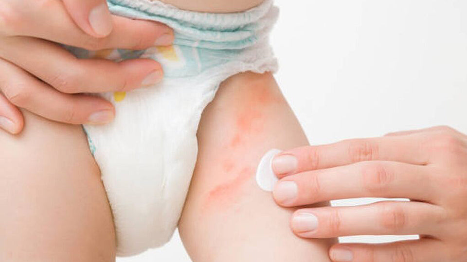 What Causes Rashes on Baby’s Skin
