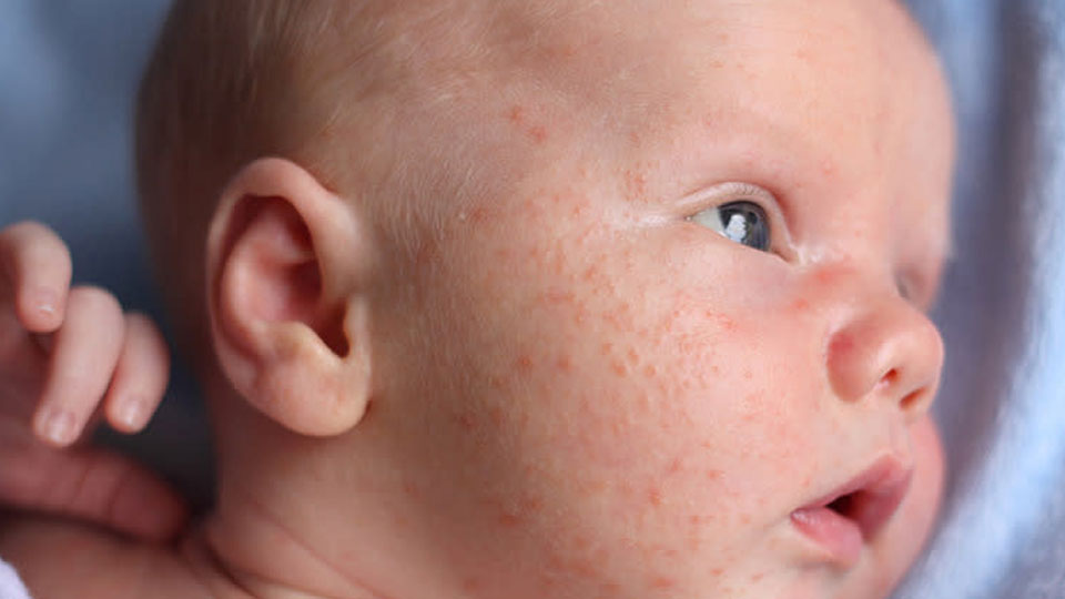 Myths Related to Rashes on Baby’s Skin