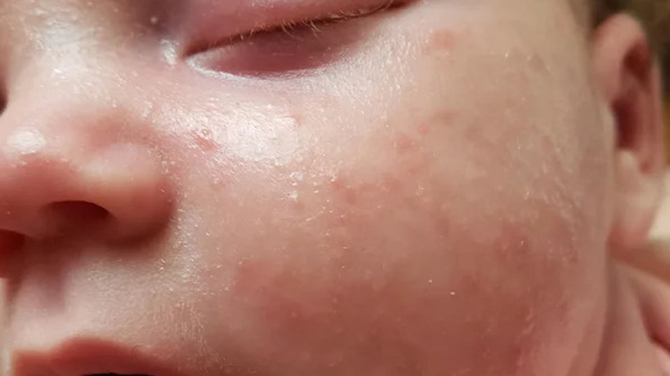 Acne on Newborn Baby