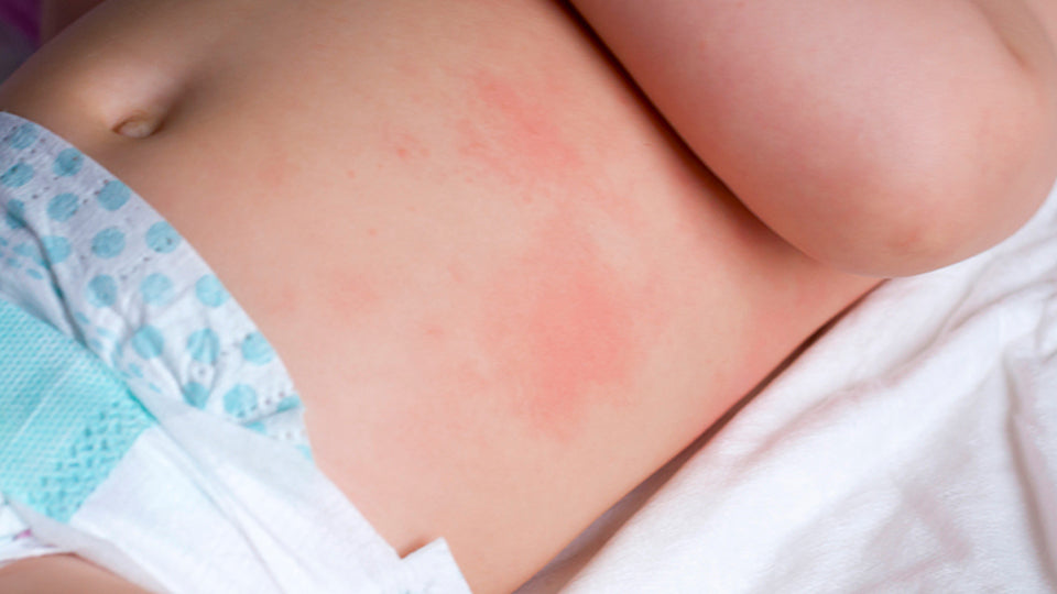 Common Rashes in Babies